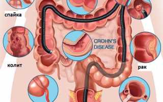 Что представляет собой колоноскопия и как ее делают?