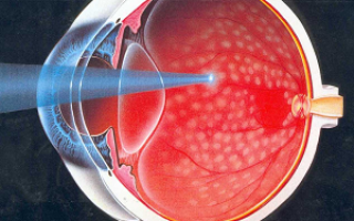 Симптомы и лечение диабетической ретинопатии