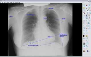 Что показывает рентген грудной клетки?