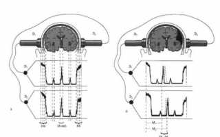 Особенности метода эхоэнцефалографии головного мозга