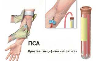 Выявление рака предстательной железы анализом крови на ПСА