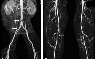 Ангиографическое исследование сосудов ног