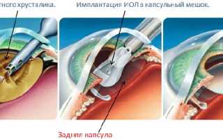 4 вида вторичной катаракты и прогноз