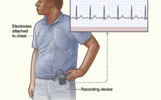 Суточное мониторирование — холтер ЭКГ