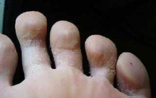 Опрелость между пальцами ног