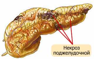 Прогноз после операции при панкреонекрозе поджелудочной железы