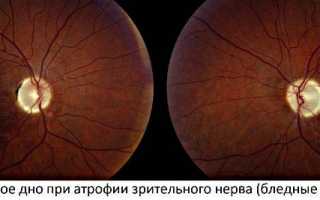 Как и чем вылечить атрофию зрительного нерва