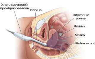 Определение заболеваний при помощи УЗИ мочевого пузыря