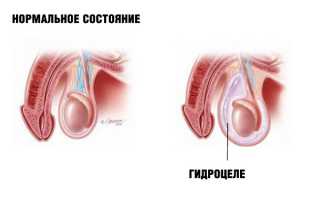 Водянка яичек у мужчин: симптомы и лечение гидроцеле