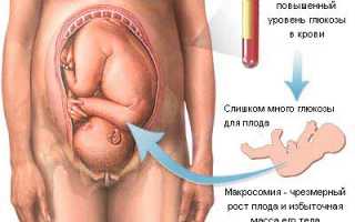Сахар в крови у беременных — норма и патология