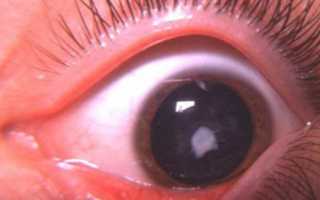 6 типов врожденной катаракты и их особенности