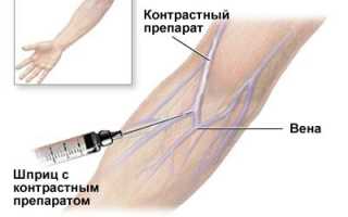 Процедура экскреторной урографии