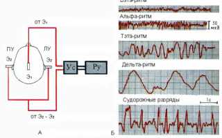 Оценка активности мозга на электроэнцефалографии (ЭЭГ)
