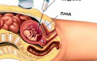 Какие патологии можно выявить на амниоцентезе?