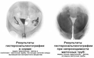 Как делают рентген маточных труб?