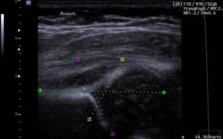 Расшифровка УЗИ тазобедренного сустава у грудничков