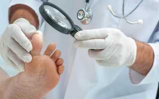 Какой врач лечит грибок ногтей