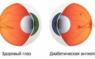 Как лечить ангиопатию сетчатки глаза