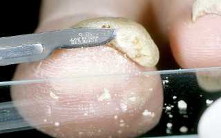 Анализы на грибок ногтей