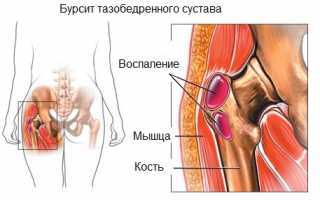 Что показывает УЗИ тазобедренного сустава?