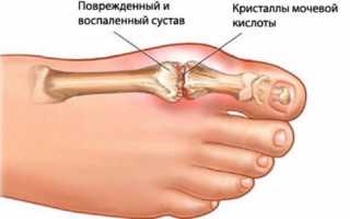 Если мочевая кислота в крови повышена — что делать?