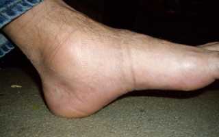 Отек ног у мужчин: причины и лечение