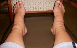 Отек ног: диагностика и эффективное лечение