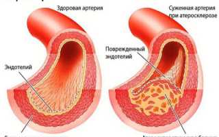 Атеросклероз брахиоцефальных сосудов: симптомы и лечение