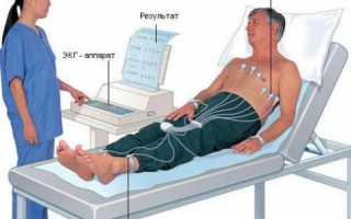 В каких случаях и как делают ЭКГ сердца?