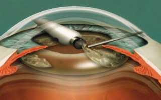 Особенности и преимущества факоэмульсификации катаракты