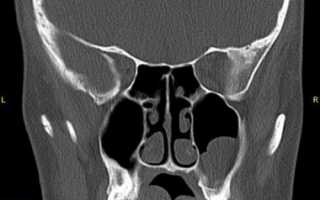 Когда назначают КТ околоносовых пазух?