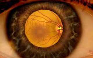 Причины и способы исцеления отека сетчатки глаза