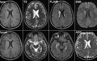 Какое исследование лучше — КТ или МРТ головного мозга?