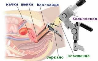 Что такое кольпоскопия шейки матки?