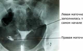 Проведение процедуры гистеросальпингографии