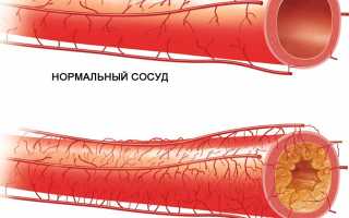 Липиды в крови — что показывает липидограмма?