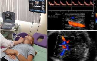Когда проводят допплерографию сосудов головы и шеи?