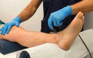 Трофические язвы на ногах: лечение ран на правой и левой голени