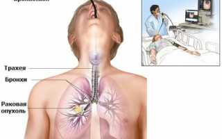 Виды и проведение биопсии легких