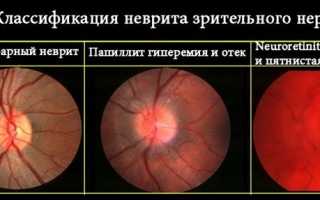 Лечение неврита зрительного нерва