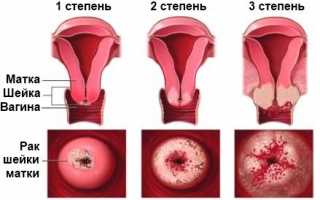 Процедура биопсии шейки матки при эрозии