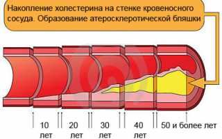 Формула расчета коэффициента атерогенности