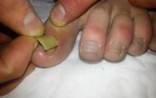 Удаление ногтей пораженных грибком — самые эффективные методы