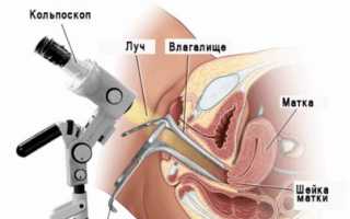 Можно ли делать кольпоскопию при беременности?