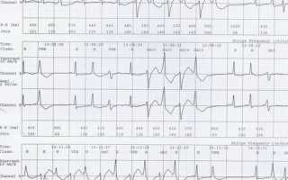 Полная картина работы сердца на холтеровском мониторировании ЭКГ