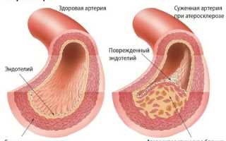 Атеросклероз нижних конечностей: медикаменты и народная терапия
