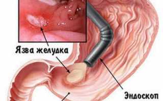 Назначение ФГС желудка (фиброгастроскопии)