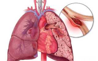 Тромбоэмболия легочной артерии – как распознать и лечить опасное заболевание?
