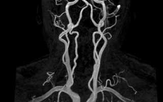 Проверка сердечно-сосудистой системы на МРТ сосудов