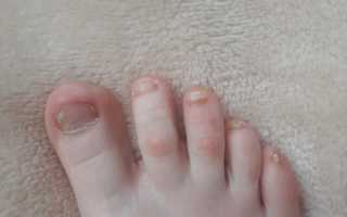 Грибок ногтей у детей: как выглядит, чем лечить?